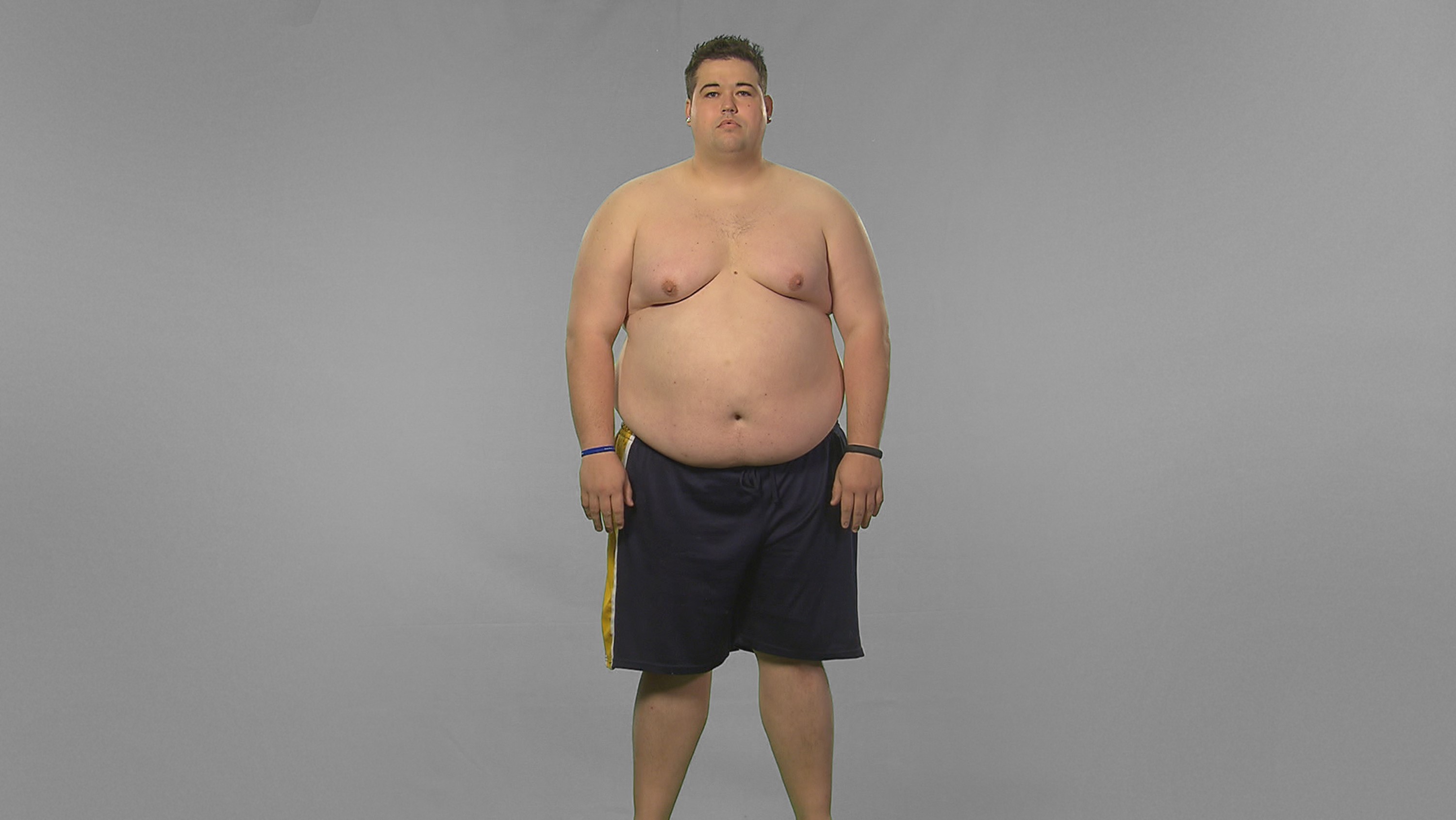 “extreme Weight Loss” Davids Journey Begins At The University Of Colorado Anschutz Health And